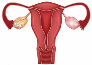 Είναι κληρονομικός ο καρκίνος του ενδομητρίου;