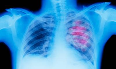 Η εμφάνιση του καρκίνου του πνεύμονα σε άνδρες και γυναίκες