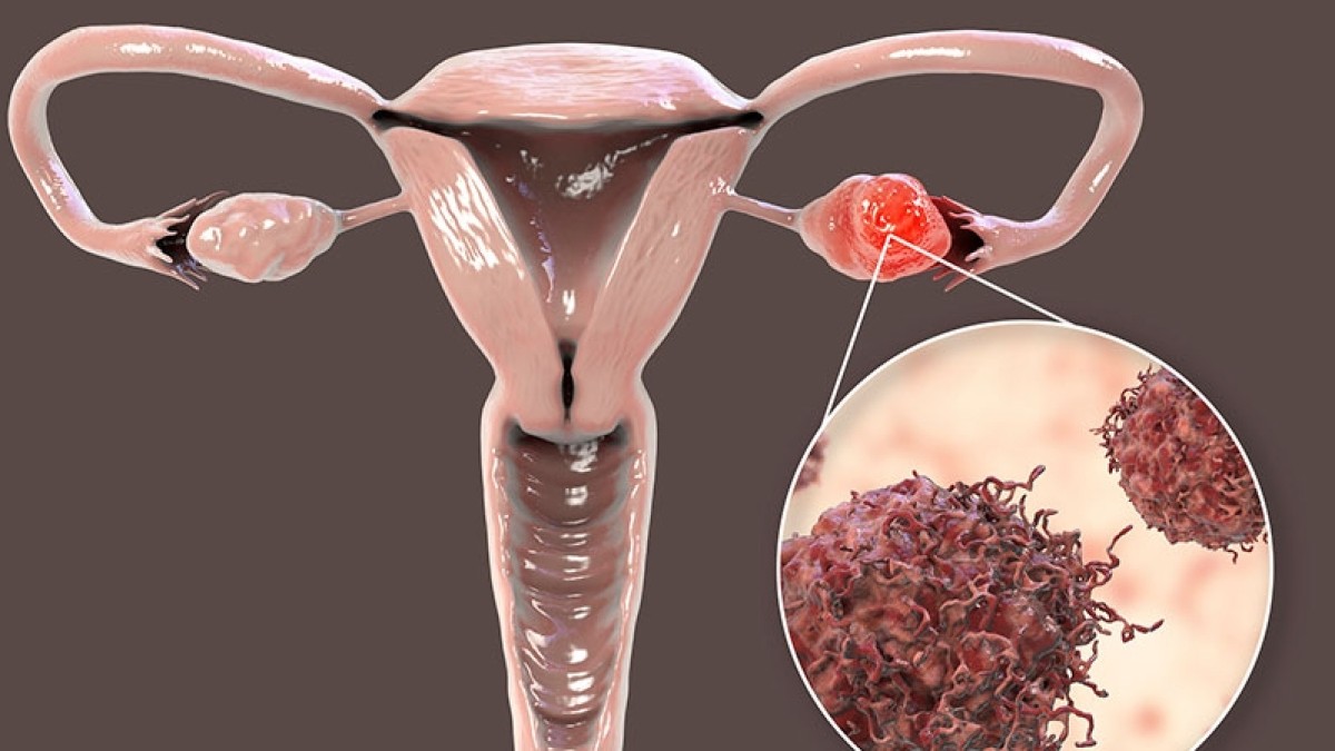 Έρευνα: Νέα μέθοδος ανίχνευσης του καρκίνου των ωοθηκών από δείγμα ούρων
