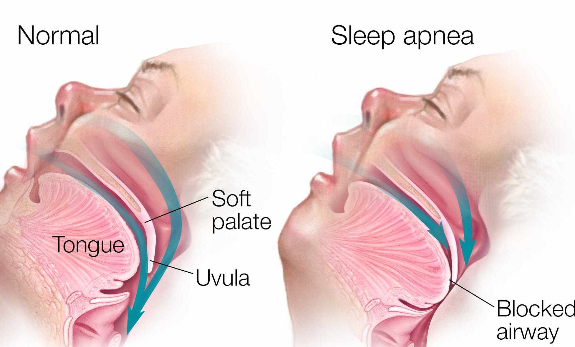 Medical illustration of sleep apnea