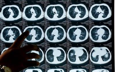 Γαλλία: Ασθενής έχασε τη ζωή της από καρκίνο ύστερα από μεταμόσχευση πνευμόνων από καπνίστρια