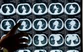 Γαλλία: Ασθενής έχασε τη ζωή της από καρκίνο ύστερα από μεταμόσχευση πνευμόνων από καπνίστρια
