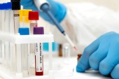 Ευλογιά των πιθήκων: 8 νέα κρούσματα σε μια εβδομάδα