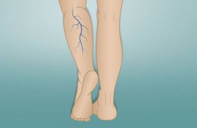 Φλεβίτιδα: Ποια συμπτώματα αποδεικνύουν πώς αποτελεί απειλή για τα πόδια σας;