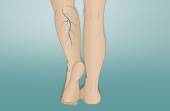 Φλεβίτιδα: Ποια συμπτώματα αποδεικνύουν πώς αποτελεί απειλή για τα πόδια σας;