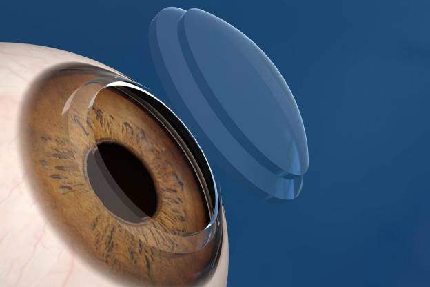 Με επιτυχία η μεταμόσχευση νέου κερατοειδούς χιτώνα σε γυναίκα σχεδόν τυφλή από το ένα μάτι