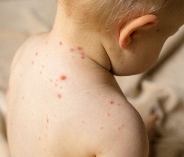 Ο ΠΟΥ προειδοποιεί για επικείμενη έξαρση κρουσμάτων ιλαράς