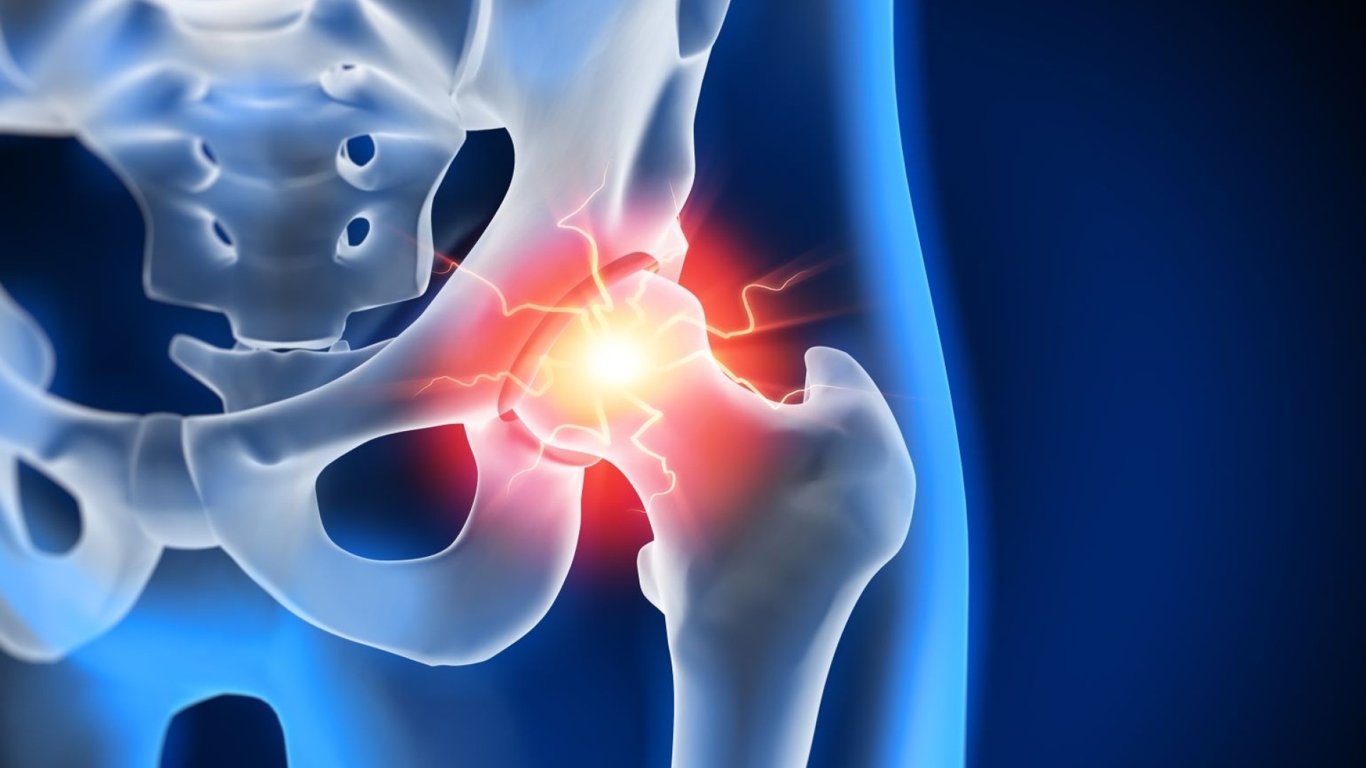 Ολική Αρθροπλαστική Ισχίου AMIS: Άμεση, ανώδυνη και ατραυματική αντιμετώπιση της επώδυνης αρθρίτιδας