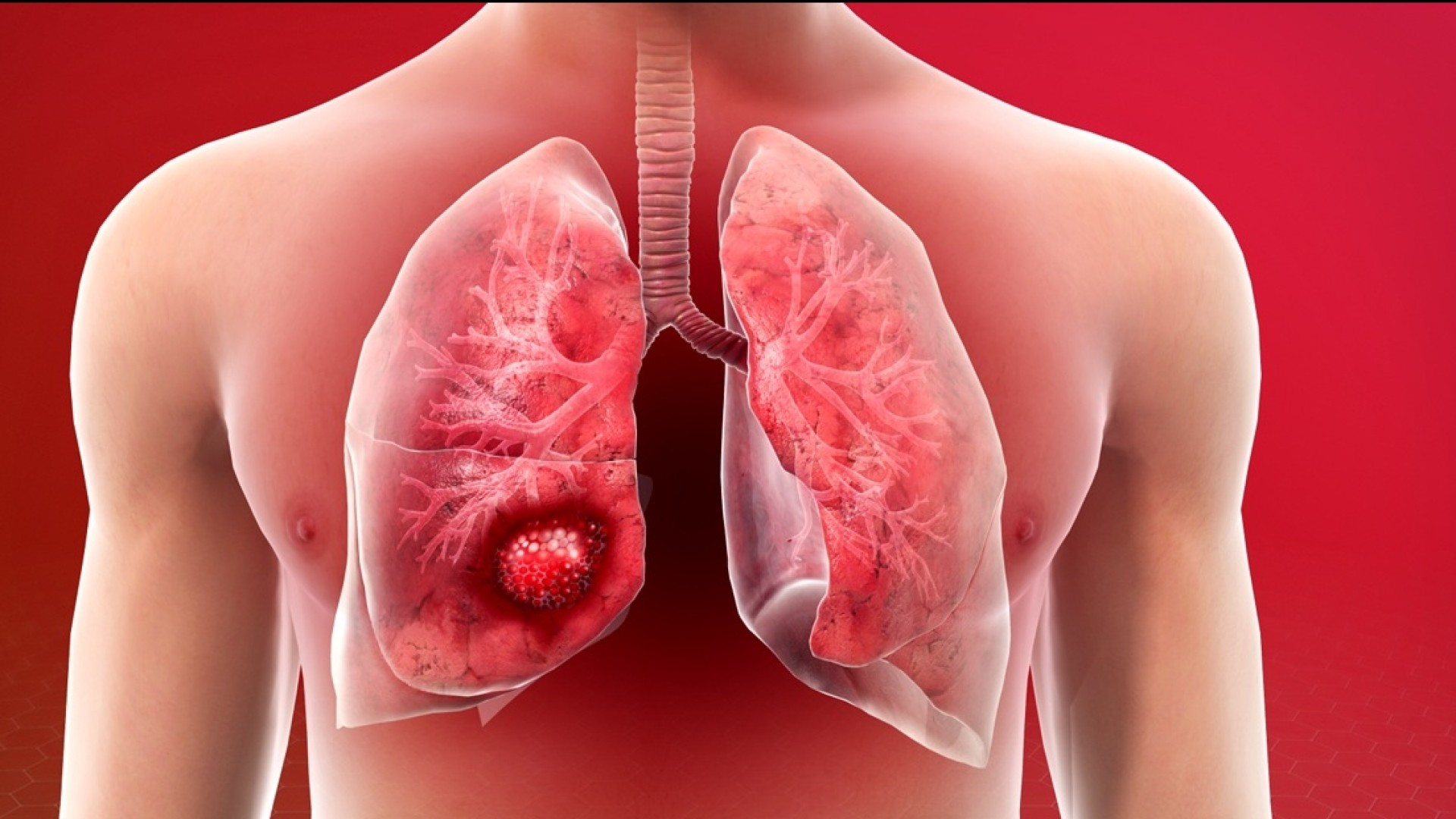 Ανεγχείρητος καρκίνος πνεύμονος:  O ειδικός μας εξηγεί τι είναι και ποια είναι η θεραπευτική προσέγγισή του