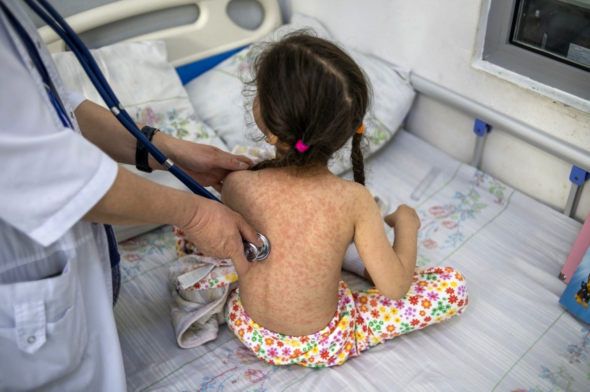 OHE: Η ιλαρά δείχνει τα δόντια της-Που καταγράφονται τα κρούσματα