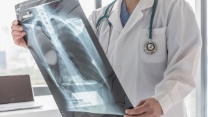 Νέα εξέταση ούρων ανοίγει δρόμους για έγκαιρη διάγνωση του Καρκίνου του Πνεύμονα